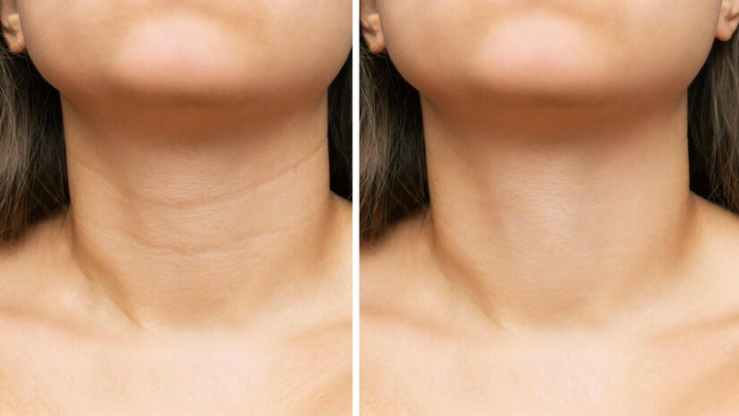 How to Treat Tech Neck Lines with Serum?